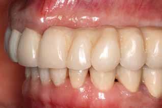 A gingivl epithesis, cting s mock-up, ws plced in the mouth during the second visit, in order to otin the ptient s opinion out the expected rehilittion, nd to confirm functionl nd esthetic