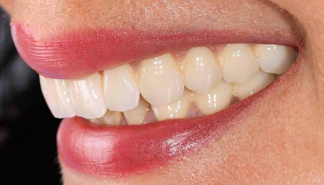CASE REPORT Fig 17 Ptient s smile with nturl ffernce of the gingiv-colored cermics rehilittion.