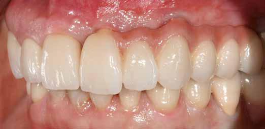 COUTO VIANA ET AL Astrct Rehilittion of edentulous spces in esthetic res is chllenge to the clinicin due to the loss of soft tissues.