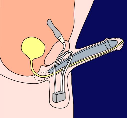 Penile prosthesis Reservoir Cylinders