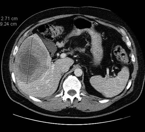 Hompland and Bruland: Imatinib in Surgically Resected Metastatic GIST (Review) Figure 3. A small solitary liver metastasis detected on a CT scan in case 3. Figure 1.