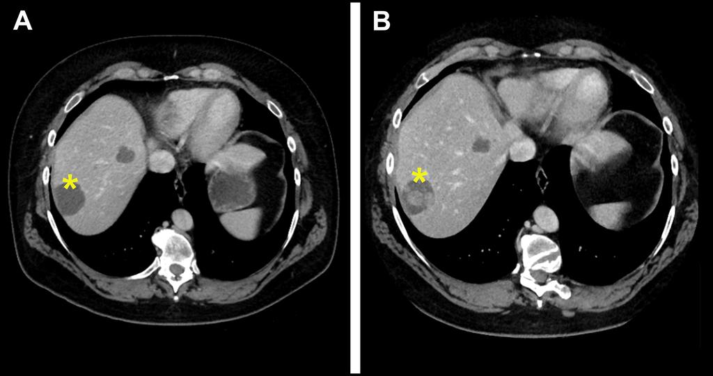 Figure 6. Patients with multiple liver metastases responding to imatinib at two years of treatment (A). Six months later a node in mass was detected (B).