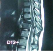MRI showed Tuberculous infection of T9