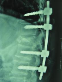 vertebroplasty was done to relieve