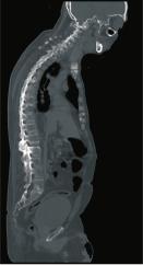 Spine Trauma Fracture in ankylosed
