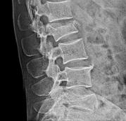 Thoraco Lumbar Spine Fracture 45