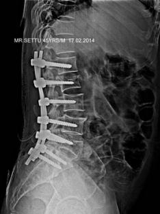 pedicle screw fixation and
