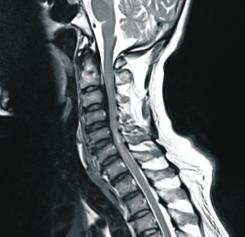 Cervical Spine Surgery Cervical Myelopathy Cervical myelopathy is a