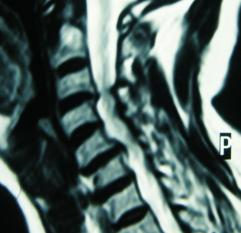 diagnosed to have multiple level cervical cord