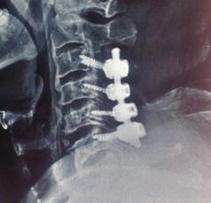 Cervical laminectomy with stabilization was done and