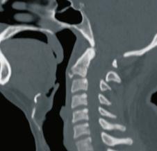 Craniovertebral Junction Surgeries Hangman's