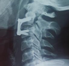 fracture with C2-C3 subluxation).