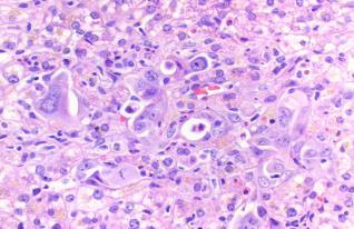 Cancer of Unknown Primary Our Experience Let s go back case 2 68 year old female with liver mass lesions Breast triple-negative carcinoma 9 years ago Liver, Mass, Biopsy: - Metastatic poorly
