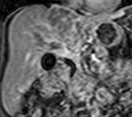 MR Coronal Image in the Delayed Phase Non-cirrhotic liver, lesion within segment 8/4 associated with