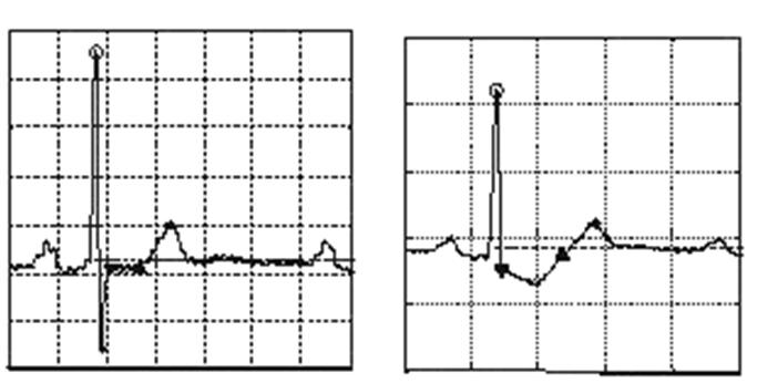 ampltude whle the hgh frequency noses are decreased greatly and the low frequency noses are weak, so the R wave s extracted at S= scale.