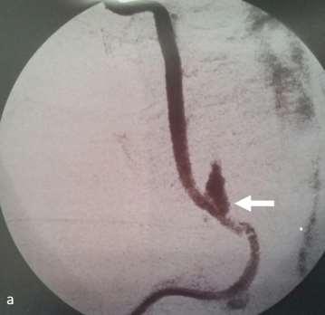 Case Report- Endovascular Repair Active extravasation from the