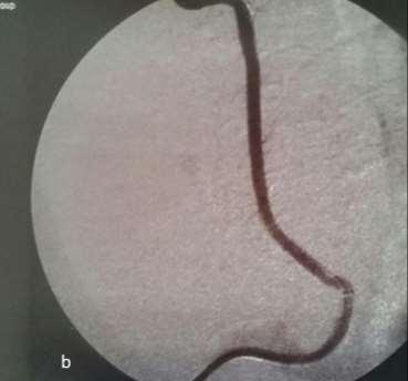 Case Report- Endovascular Repair Rapid exchange BE covered-stent 4 X 20 mm (PK Papyrous, Biotronic, Switzerland) in the V2 segment of the RVA covering the extravasation point.