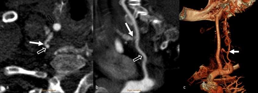 Case Report-Day 3 Neck CTA : active extravasation from the V1-2 segment of the right vertebral artery.
