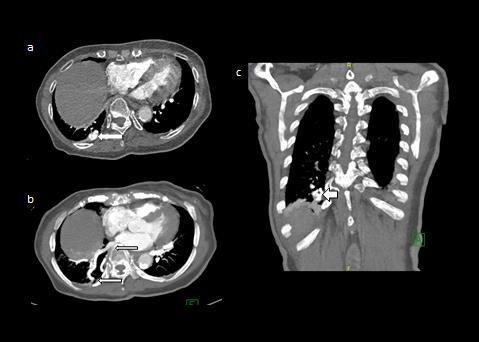 The radiological impression was multiple pulmonary arteriovenous malformations with right with associated lung infective changes.