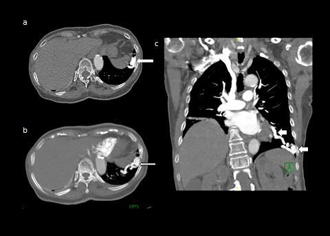 Figure 4: CT scans of thorax (a,b) in axial views (c) in coronal view demonstrating another similar well circumscribed arteriovenous malformation (long arrows) at the left lower lobe connected by a