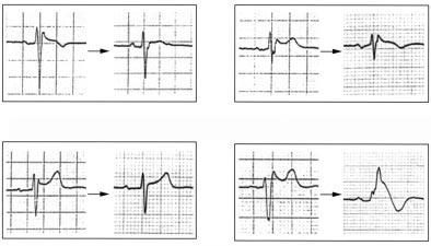 164 Furuhashi, Uno, Tsuchihashi, et al Coved type ST shift Saddle back type ST shift Initial evaluation Follow up 3 5 8 2 No RBBB/ST shift 4 ( progression of conduction disturbance from IRBBB to