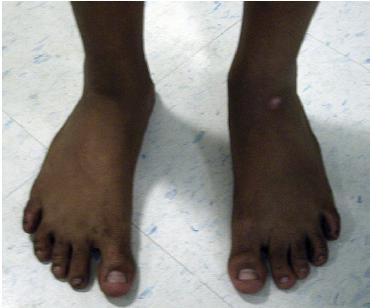 Clinical evaluation From plantar aspect Weight bearing