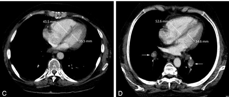 A and B represent the same patient with acute pulmonary embolism (PE) and RV/LV-ratio 1.0. Note the right sided pleural effusion, bilateral atelectasis, and diaphragmatic hernia (A, B).