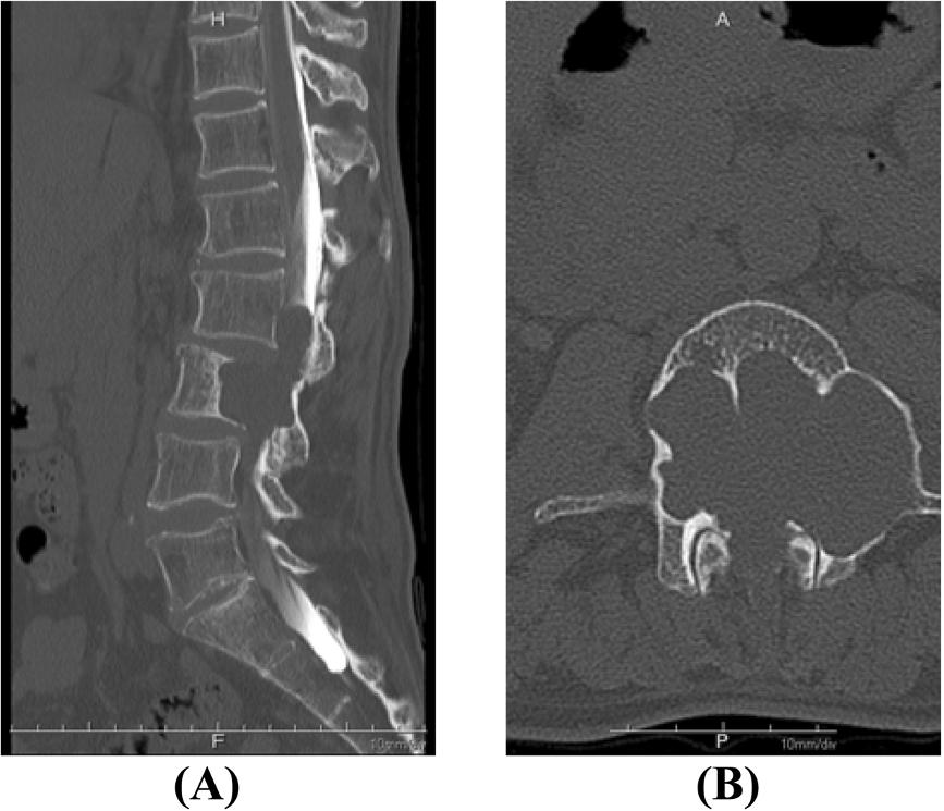 Iizuka et al. Journal of Medical Case Reports 2014, 8:421 Page 2 of 5 Figure 1 Large scalloping of the L3 vertebral body.