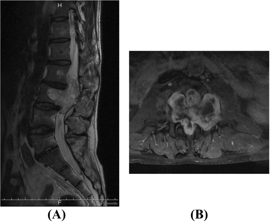 L3 vertebral body. Figure 2 Pre-operative magnetic resonance imaging scans of the lumbar spine.