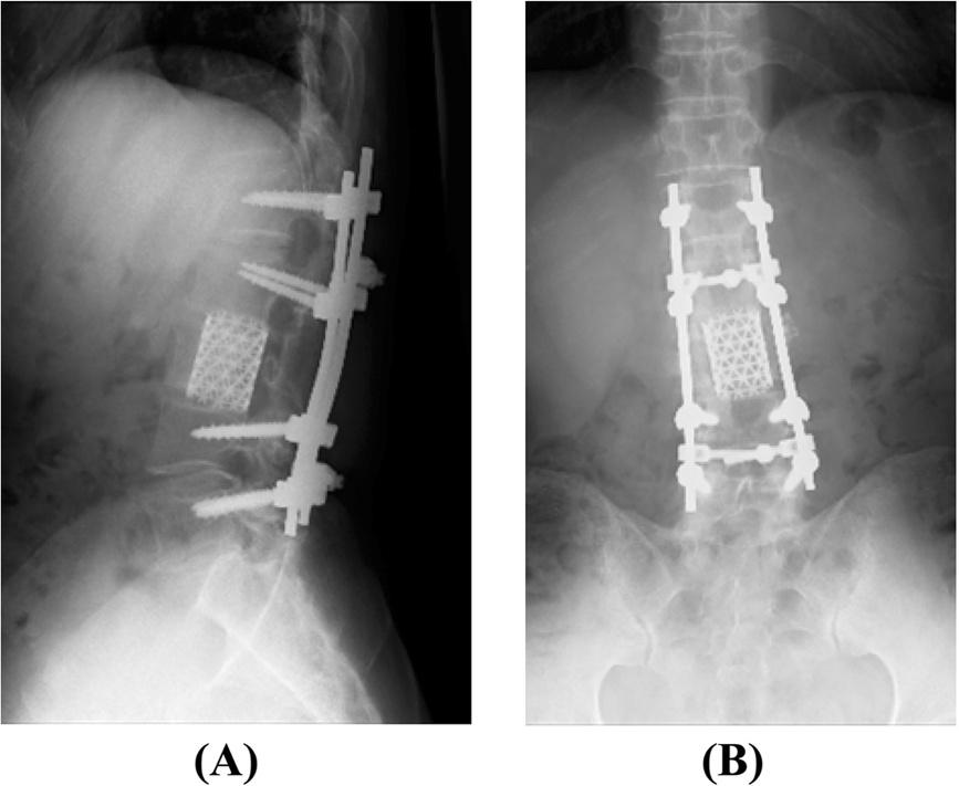 Iizuka et al. Journal of Medical Case Reports 2014, 8:421 Page 4 of 5 Figure 4 Post-operative lateral (A) and anteroposterior (B) X-ray of the lumbar spine.