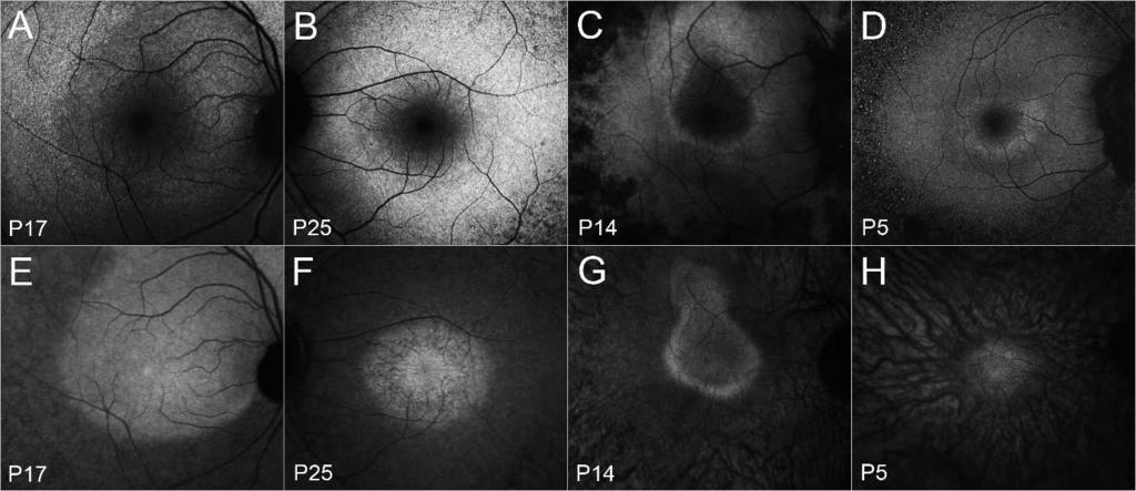 588 Duncker et al. IOVS, January 2013, Vol. 54, No. 1 FIGURE 3. SW-AF and NIR-AF images showing variably sized rings for patients P5, P14, P17, and P25.