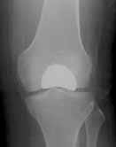 repair are increased because there is simply less bone to work with for implantation of the revision knee components.
