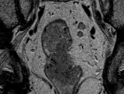 Disease does not threaten CRM (i.e. all disease is >1mm away from the mesorectal fascia or levator-sphincter complex). No distant metastases on CT scan of thorax, abdomen and pelvis. CASE 1 Case 4.