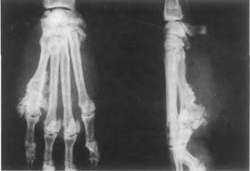 VOL. 7, No. 5 CANNE FOOT FG.. Melanoma resulting in bone destruction of the distal phalanx of the fifth digit. There is soft tissuc swelling of this digit with mild periosteal bone proliferation.