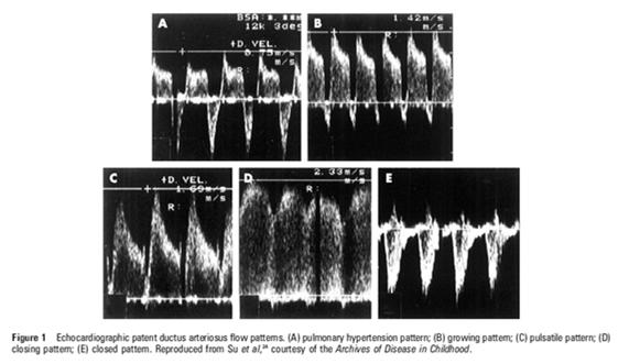 Assessment of ductal significance Possible criteria. LA:AO ratio reflecting left atrial dilation. Silverman 1974 LV output or stroke volume.