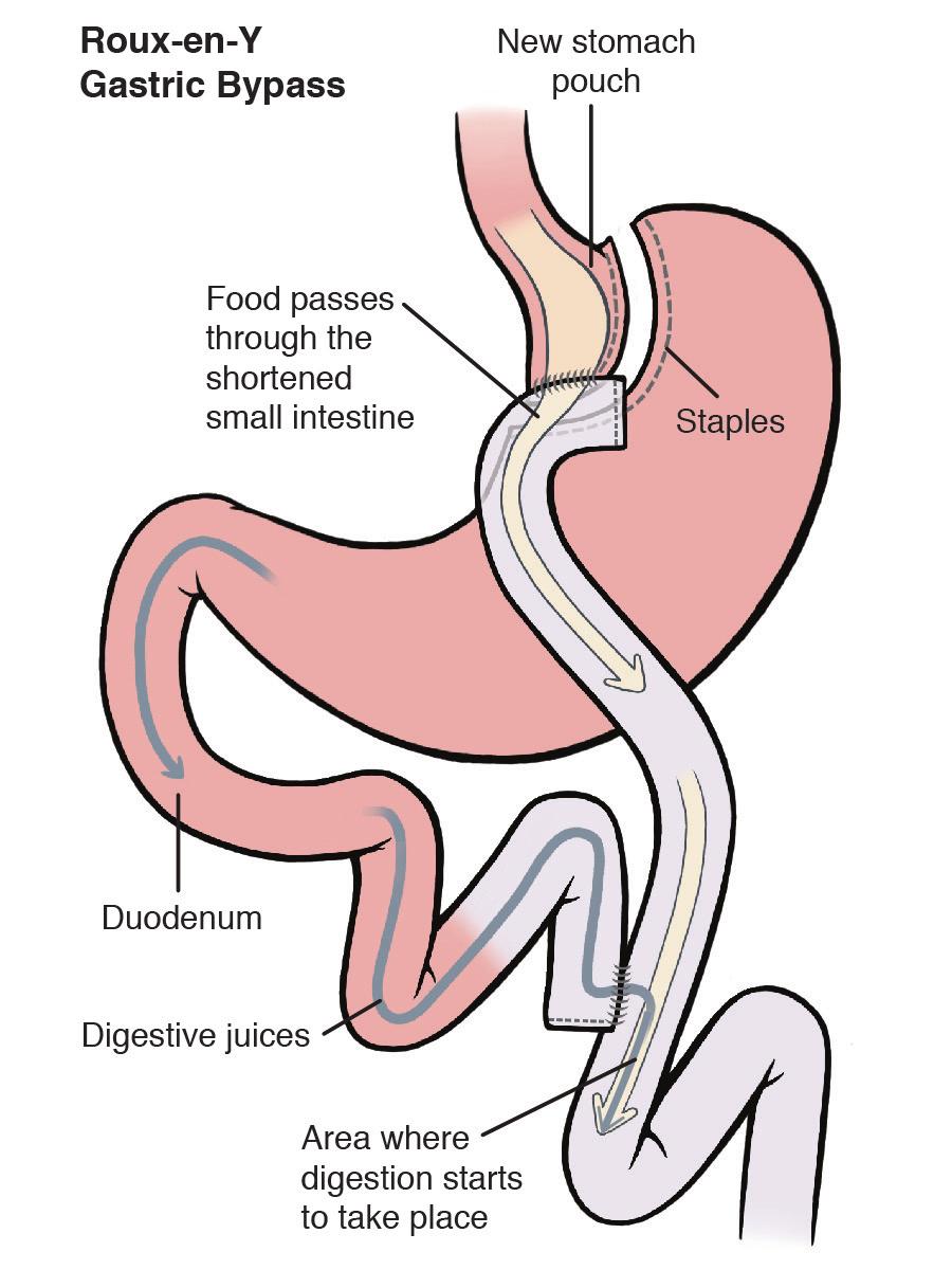 What is gastric bypass surgery? Surgery for obesity (bariatric surgery) is a way to help some patients lose weight.