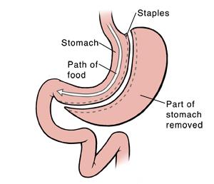 It makes the stomach much smaller which helps you eat smaller meals and feel less hungry. 2. It makes food bypass the small intestine.
