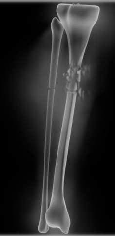 Doctors can help bones heal from breaks. But in some cases, like we can see in the X-ray above, a cast alone is not enough! Bone Activity 2: Doctor, Doctor!