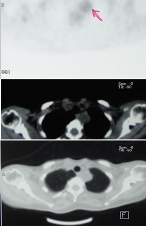 Shanghai Chest, 2017 Page 3 of 5 Operative techniques Figure 5 PET CT images: neurogenic tumor involvement of left upper posterior mediastinum.