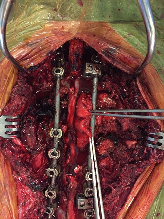 After freeing the intraspinal component of the tumor, it is pushed into the thoracic cavity. The procedure is then completed in posterolateral thoracotomy position.