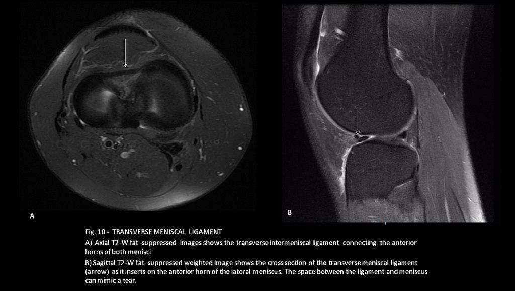 Fig. 9: - MENISCAL OSSICLE A)Lateral radiograph of the left knee shows ossicle in the joint compartment (arrow) B)Sagittal T2-W fat- suppressed MR image of the same patient depicts a meniscal ossicle