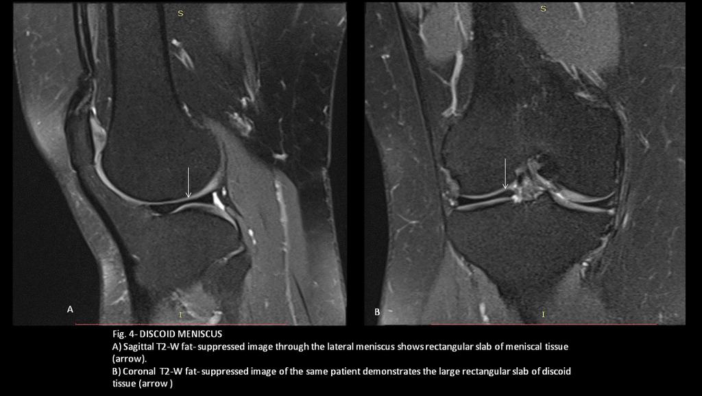 Fig. 3: - POPLITEO-MENISCAL FASCICLE Consecutive sagittal T2-W fat-suppressed images from lateral to medial in 29-year-old man with an acute ACL tear, presenting a partial rupture and thickening of