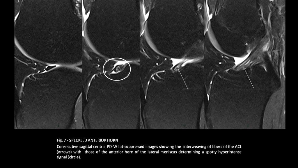 Fig. 6: - RING MENISCUS Central sagittal T1-W image of the same patient, characterizing the internal portion of the ring meniscus (thin white arrow), that could be easily mistaken for a centrally