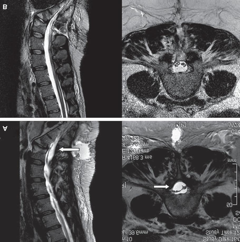 Case 1 A 71-year-old male presented with a long history of neurogenic claudication and underwent lumbar microsurgical decompression with complete resolution of his symptoms.