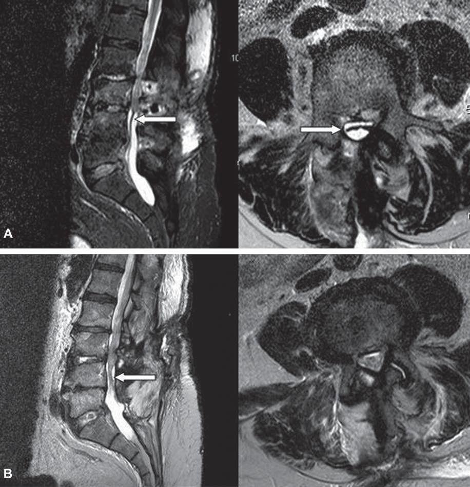 Case 2 A 31-year-old female was admitted for a revision L5/S1 microdiscectomy. Surgery was uncomplicated other than a small pinhole durotomy, with no CSF leak.
