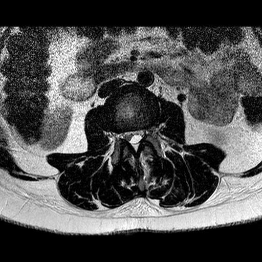 Case 3 A 54-year-old female was admitted for a primary lumbar intersegmental
