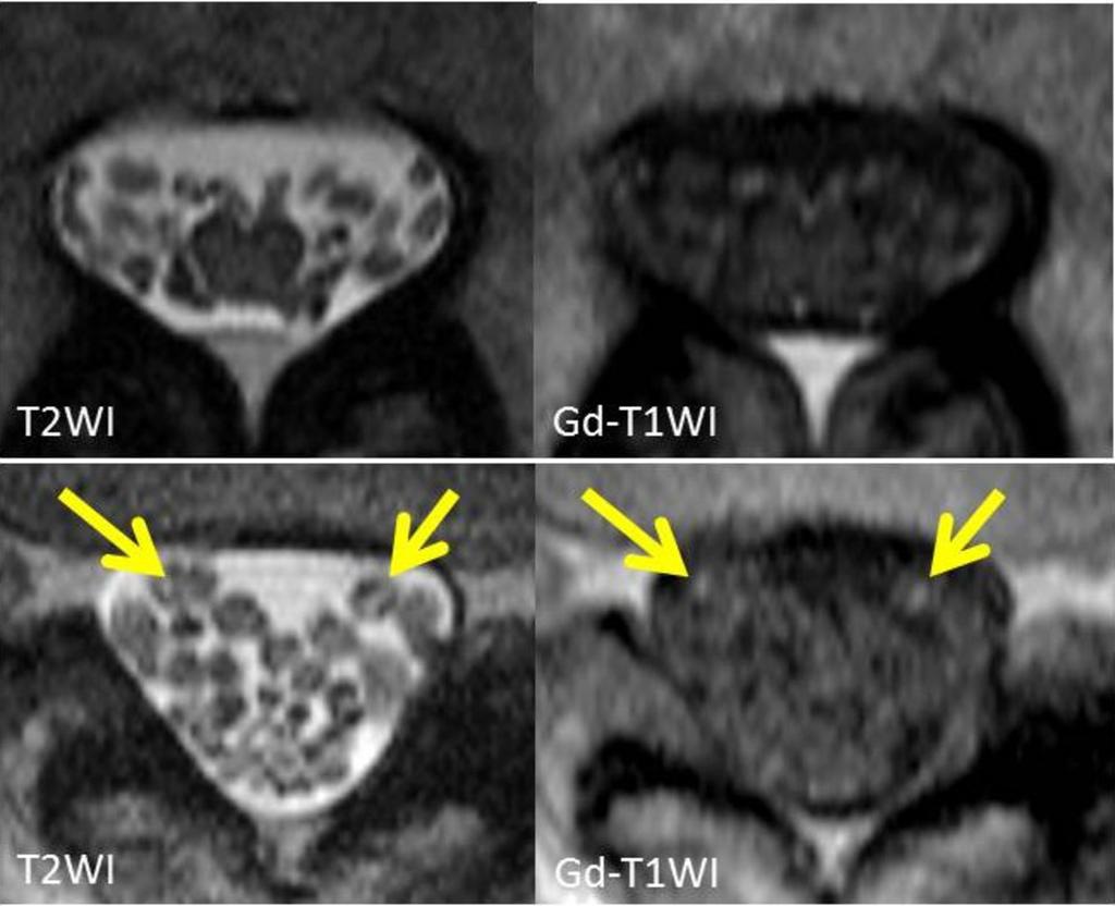 Fig. 6: Axial MR imaging of the same patient (Case 4). On T2WI, nerve roots appeared diffusely thickened. Most of the thickened nerve roots appeared slightly hypointense mainly at their rim.