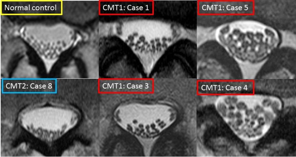 Fig. 7: Comparison of degree of thickening of cauda equina nerve roots between CMT1 and CMT2. Marked thickening of nerve roots were depicted on T2WI in patients with CMT1.