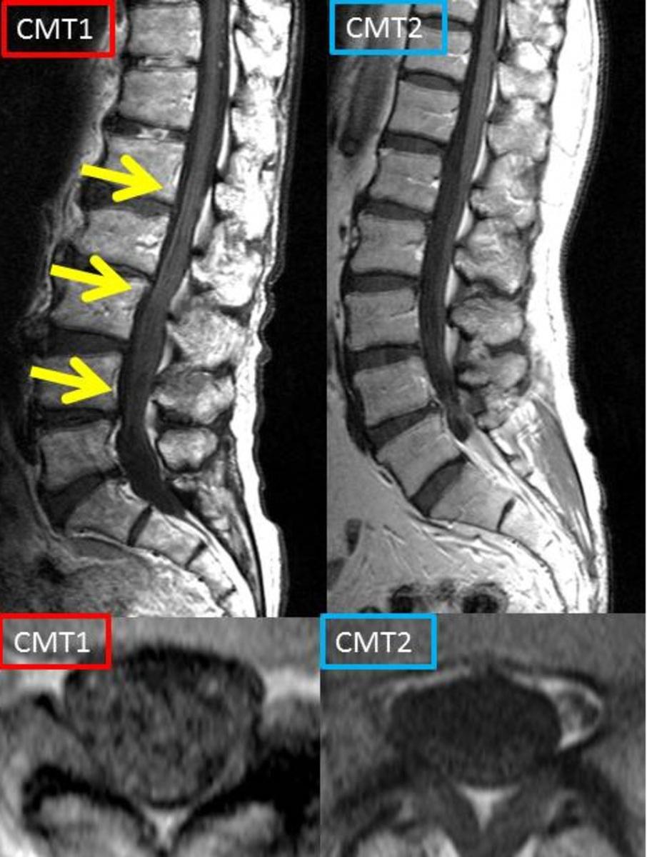 Fig. 9: Comparison of enhancing pattern in patients with CMT1 and CMT2.
