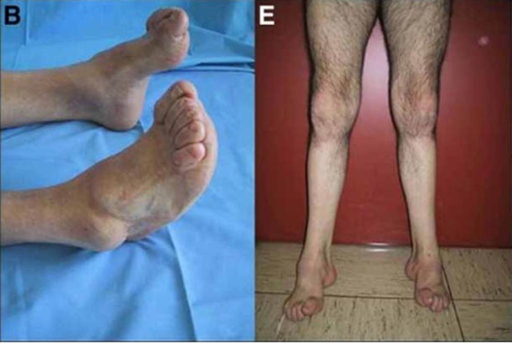 Images for this section: Fig. 1: Clinical features of Charcot-Marie-Tooth disease.